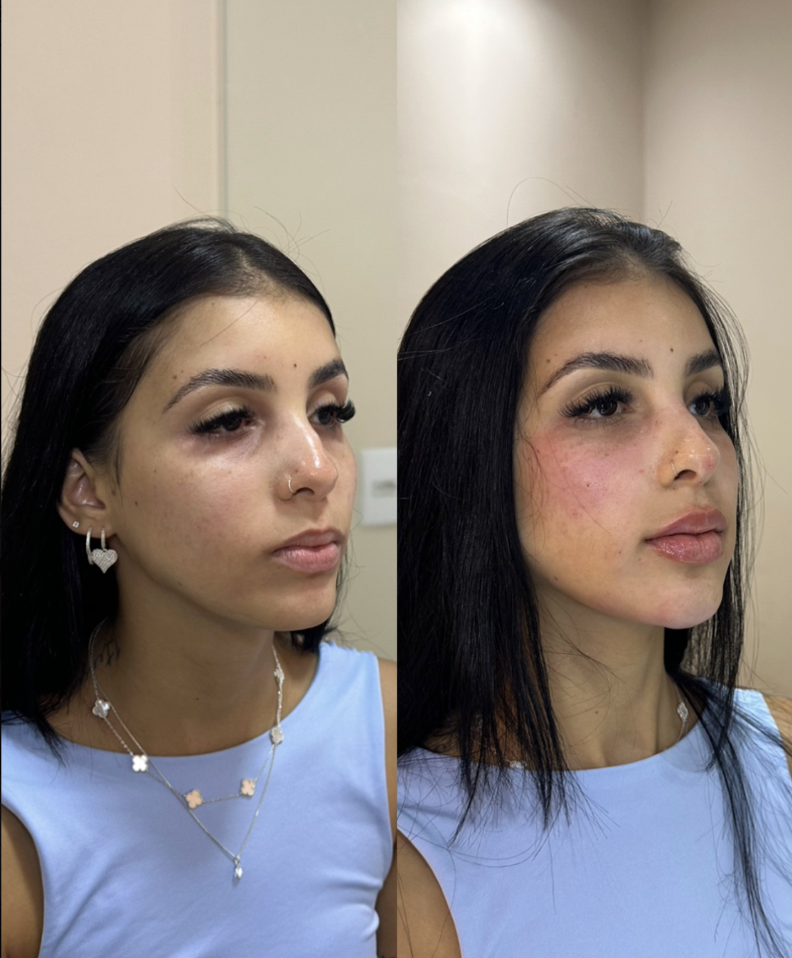 Harmonização Facial